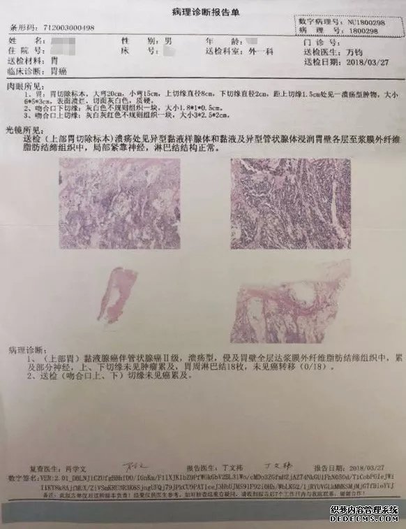 胃底部一巨大团块状黏膜隆起,后送病理活检诊断为:胃癌(胃底-贲门恶性